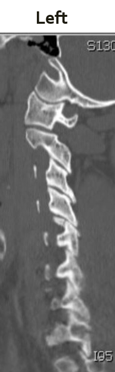 Closed Reduction of Unilateral Jumped Facet - cns.org