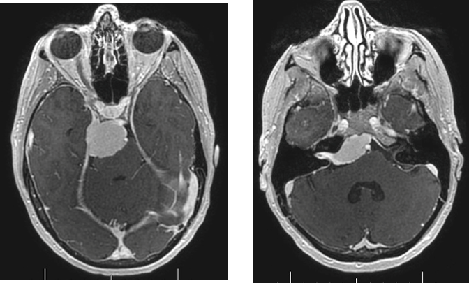 Endoscopic Endonasal Approach for Debulking of Petroclival Meningioma ...