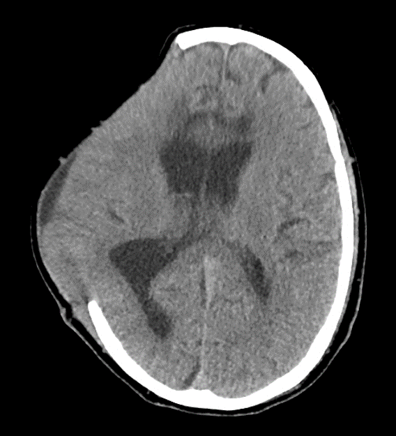 Craniectomy For Refractory Intracranial Hypertension - Cns.org