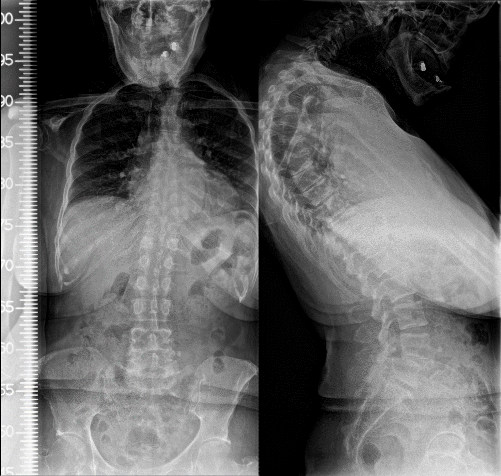 Chin-on-chest deformity in female with cervicothoracic kyphosis - cns.org