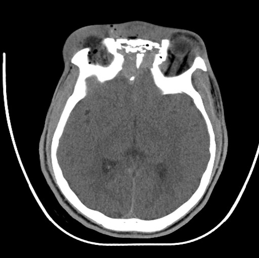 Frontal Sinus Fracture Bifrontal Craniotomy 