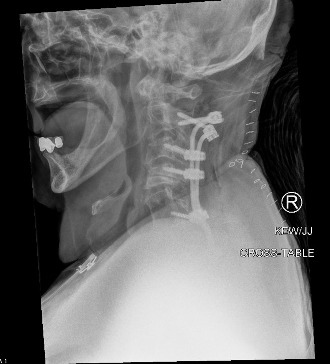 C2 Translaminar Screw Fixation for Revision of Failed Posterior ...